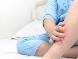Mengenal Alergi Susu Sapi pada Anak, Bisa Bahaya Bila Dibiarkan